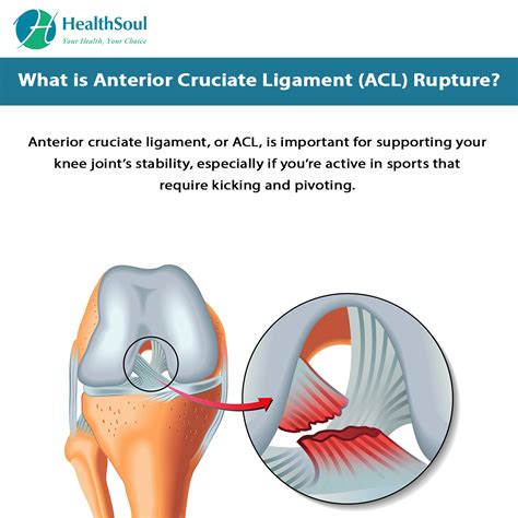 Anterior Cruciate Ligament (ACL) Rupture: Symptoms and Treatment – Healthsoul