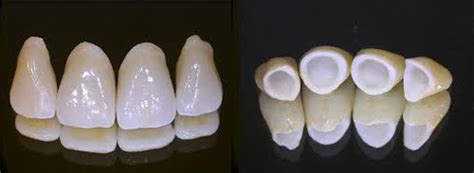 Advantages and Disadvantages of Zirconia Crowns | Dr. Ari Greenspan Dentist