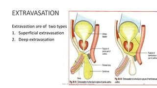 Urinary extravasation | PPT