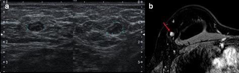 Intramammary lymph nodes: Normal and abnormal multimodality imaging features. | Semantic Scholar