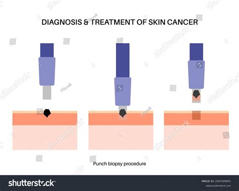 Punch Biopsy Procedure Cutting Tissue Surface Stock Vector (Royalty ...