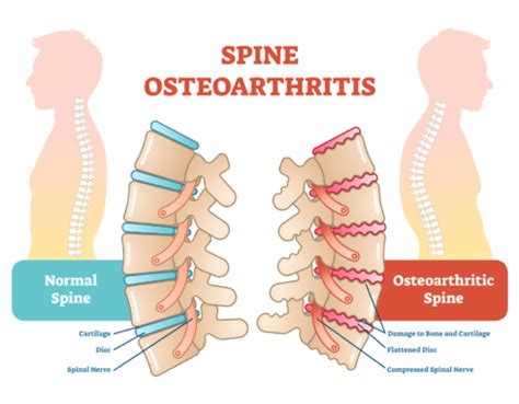 Spinal Arthritis Treatment: Spinal Arthritis Therapy & Causes| QI Spine