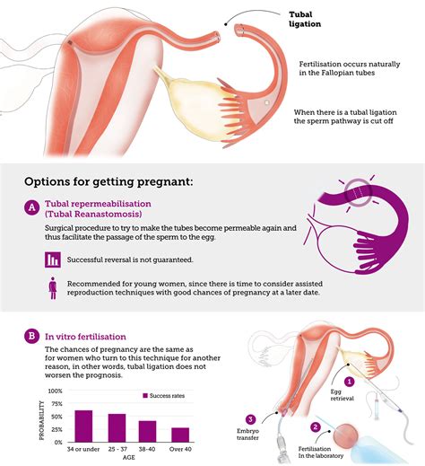 Can I Get Pregnant after Tubal Ligation? | Eugin IVF Clinic