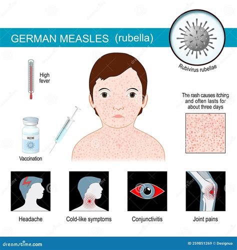 German Measles. Infographics about Symptoms of Rubella Stock Vector ...