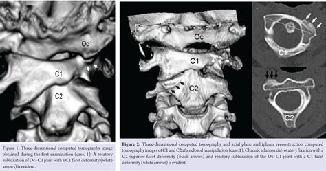 C1 C2 Subluxation Treatment - Pregnant Center Informations