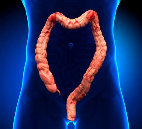 Treatment Of Ulcerative Colitis - Net Health Book