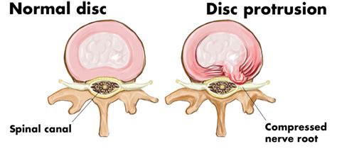 L5 S1 Disc Protrusion—Causes and Treatment of Back Pain Caused by a Slipped/Herniated Disc ...