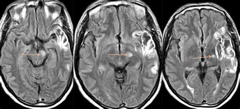 Wallerian degeneration - Large infarct in a left middle cerebral artery ...