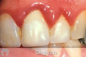 Gum Disease: Gingivitis & Periodontitis - Types, Causes & Treatment