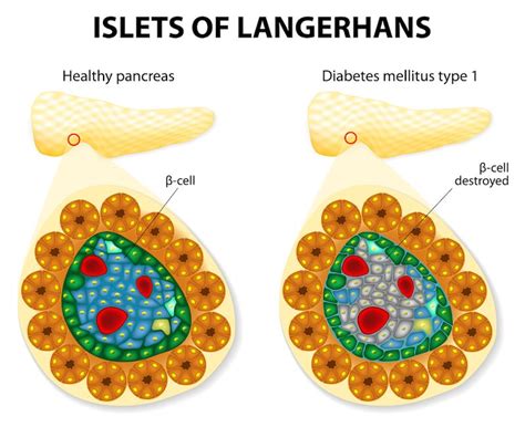 Long-Sought 'Attack' Signal in Type 1 Diabetes Identified | Live Science