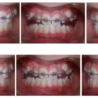 (PDF) Functional treatment of maxillary hypoplasia and mandibular prognathism