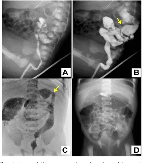 Figure 1 from How to avoid unnecessary surgical treatment for neonatal ...