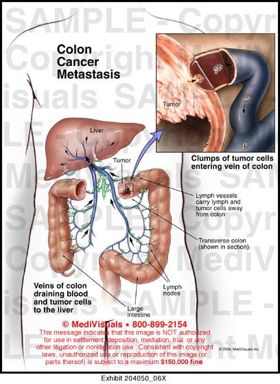 Colon Cancer Metastasis Medical Exhibit Medivisuals