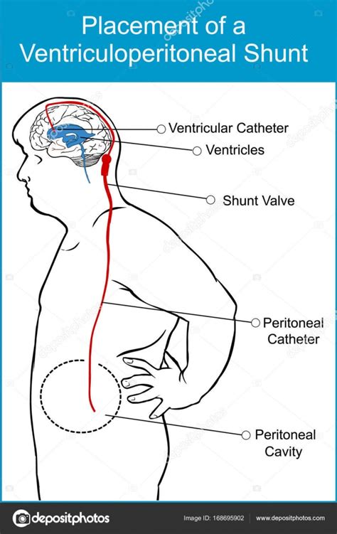 Ventricular Peritoneal Shunt Placement