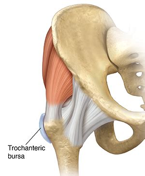 Understanding Trochanteric Bursitis