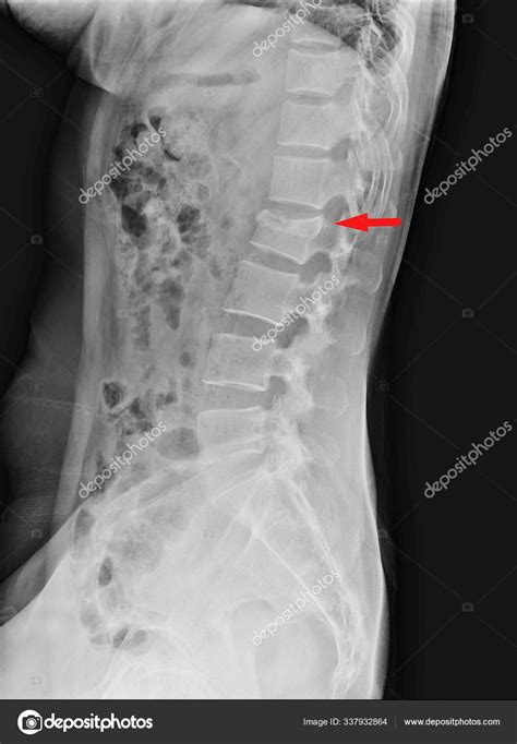 Lumbar spine compression fracture of L2. — Stock Photo © Richmanphoto ...