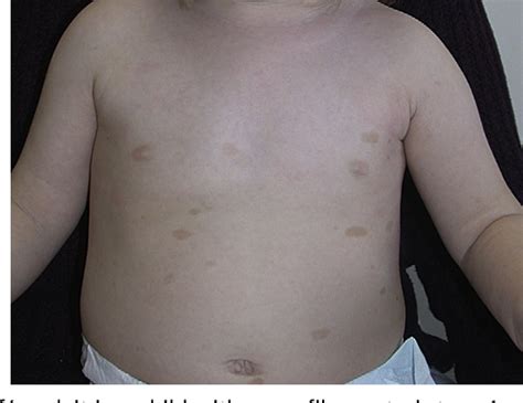 Figure 3 from The diagnostic and clinical significance of café-au-lait macules. | Semantic Scholar