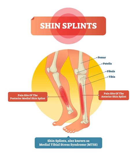 Understanding Shin Splints: Causes, Symptoms, and Treatment