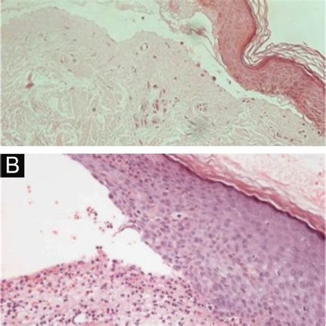 (PDF) Epidermolysis bullosa acquisita