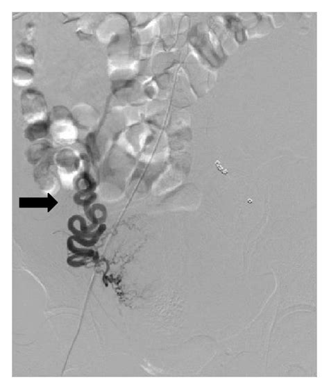 Post-left ovarian artery embolization: this shows microcoils placed ...