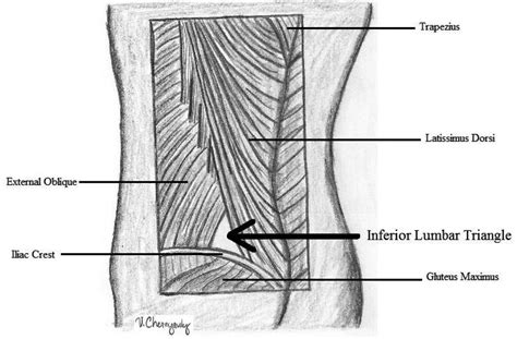 Repair of a Traumatic Lumbar Hernia With Biosynthetic Mesh: A Novel ...