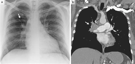 Westermark Sign in Pulmonary Embolism | NEJM