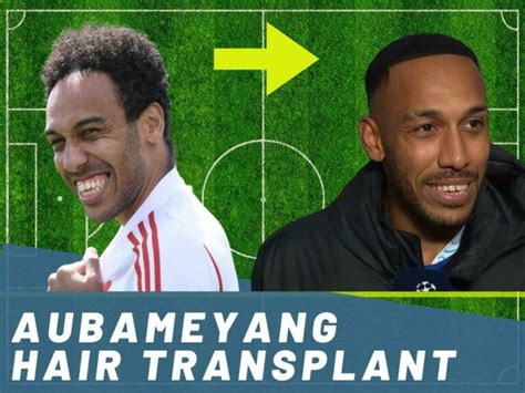 Aubameyang Hair Transplant - Hair Loss & Technical Analysis