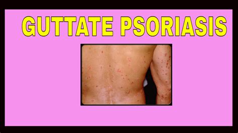 Guttate Psoriasis Oorzaken Symptomen En Behandeling M - vrogue.co