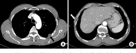 Figure 2 from A Case of Double Primary Neurilemmoma on Both Chest Wall ...