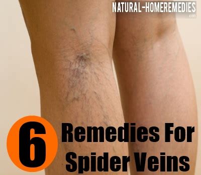 Top 6 Home Remedies For Spider Veins – Natural Home Remedies & Supplements