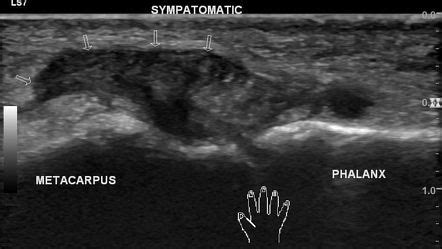 Stener lesion | Radiology Reference Article | Radiopaedia.org