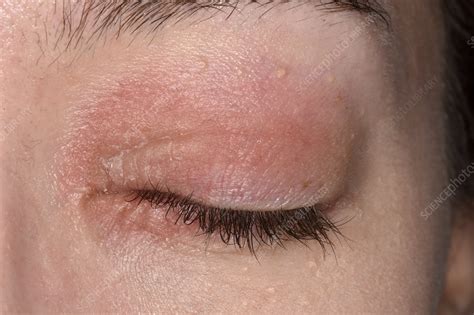 Eczema affecting the eyes - Stock Image - C047/2829 - Science Photo Library