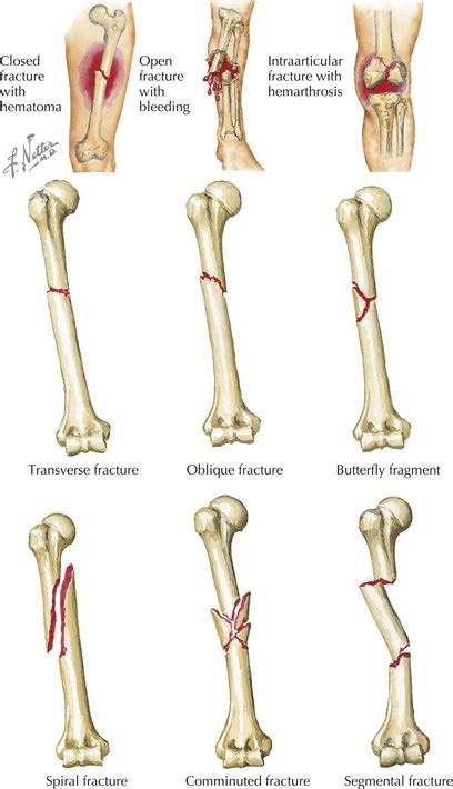 Common Fractures | Obgyn Key