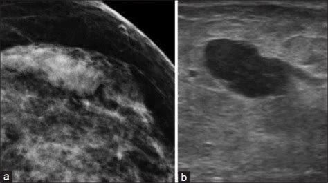 (a) Mammographic image of a medullary carcinoma, which was missed on ...