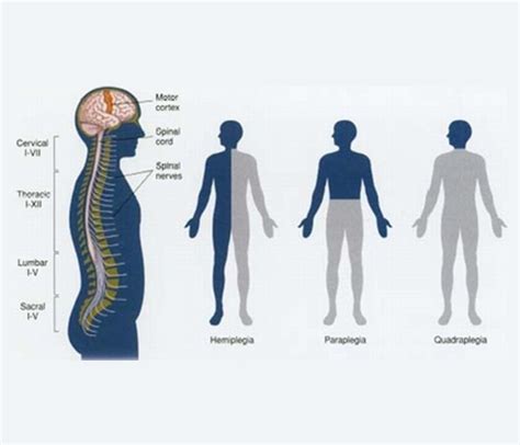 New York City Quadriplegia Lawyer | Paralyzed from neck down in NYC