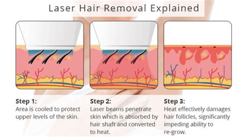 Laser Hair Removal | Faciem Dermatology Clinic