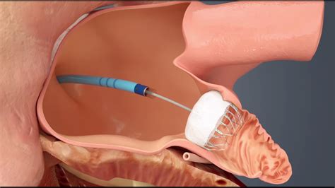 Watchman Implant Device for AFib - YouTube