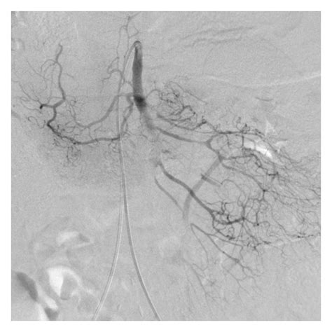 Angiography shows occlusion of the SMA with missing branches ...