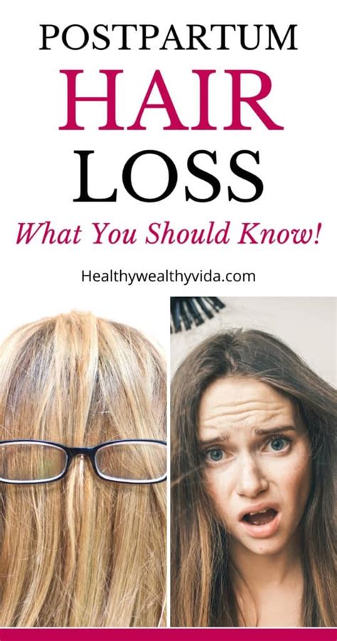 Postpartum Hair Loss And The Things You Should Know!