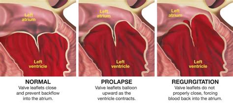 Mitral valve prolapse | Child Heart Specialist - Paediatric Cardiologist