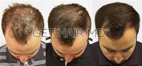 Clinical Hair Growth Laser - GetHairMD™