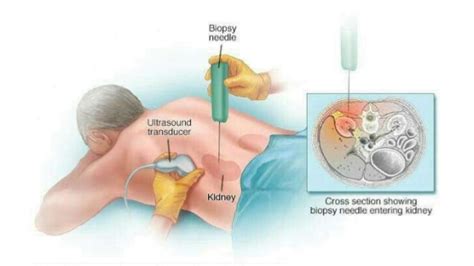 Can You Biopsy A Kidney - HealthyKidneyClub.com