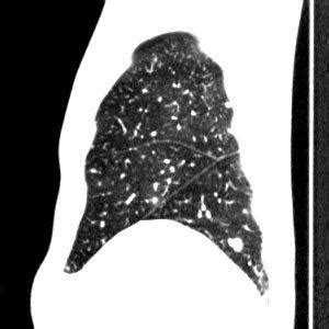 Sagital view of the right lung showing the oblique and horizontal ...