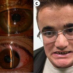 Images of the patient with Axenfeld-Rieger syndrome. a Right eye with ...