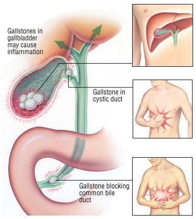 Cholecystitis Guide: Causes, Symptoms and Treatment Options