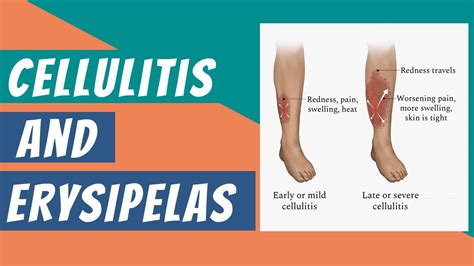 What are Cellulitis And Erysipelas? | it's Clinical features - Diagnosis & Treatment ...