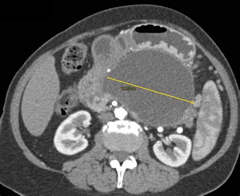 Pancreatic Pseudocyst Occludes the Splenic Vein with Extensive Collaterals Seen - Pancreas Case ...