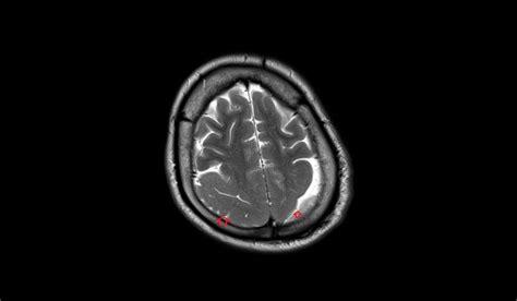 Pachygyria MRI | Radiology Article on Oligodendroglioma