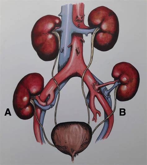 Renal Transplantation - TeachMeSurgery