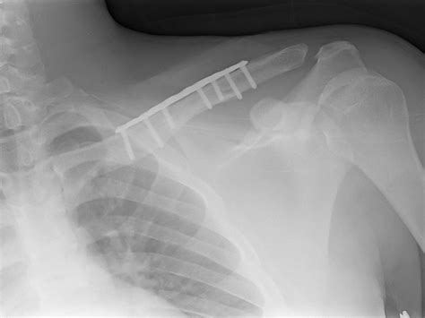 Clavicle Plating System | Acumed